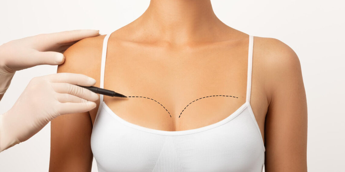 Lifting mamar, augmentare mamară, implanturi mamare – diferențe și recomandări